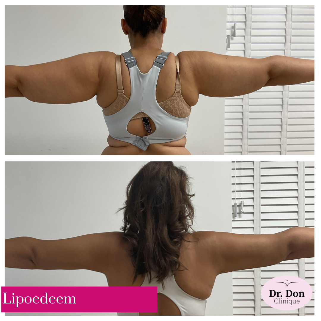 Lipoedeem armen Lipoedeem armen